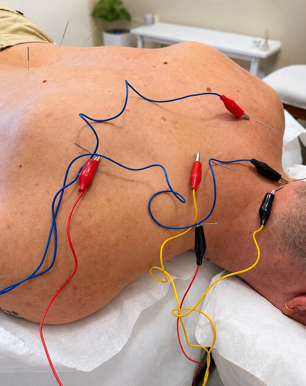 Electroacupuncture